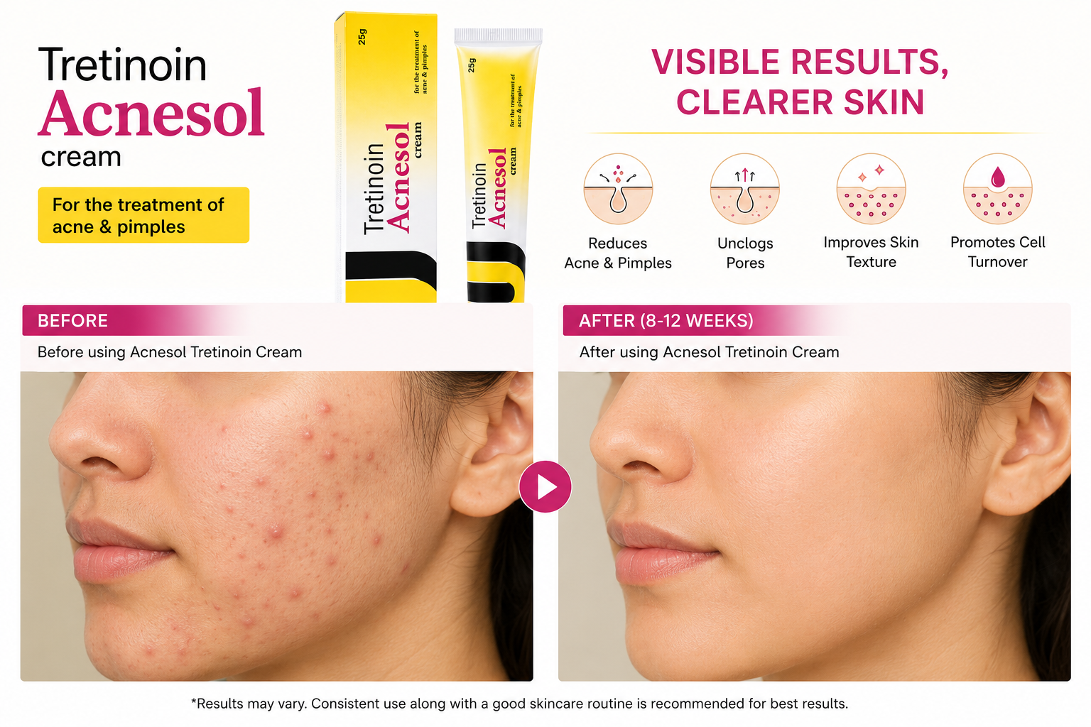 Acnesol Tretinoin Cream 25g – Acne & Pimples Treatment Retinoid Cream for Clearer Skin