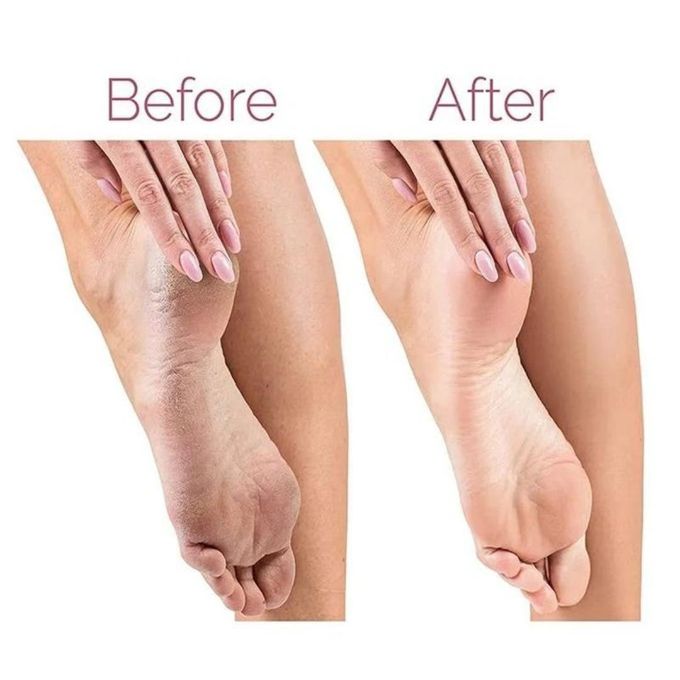 Electric Callus Remover, Foot Scrubber Rechargeable Pedicure Callus Remover Foot File Kit Feet Skin Care Pedicure