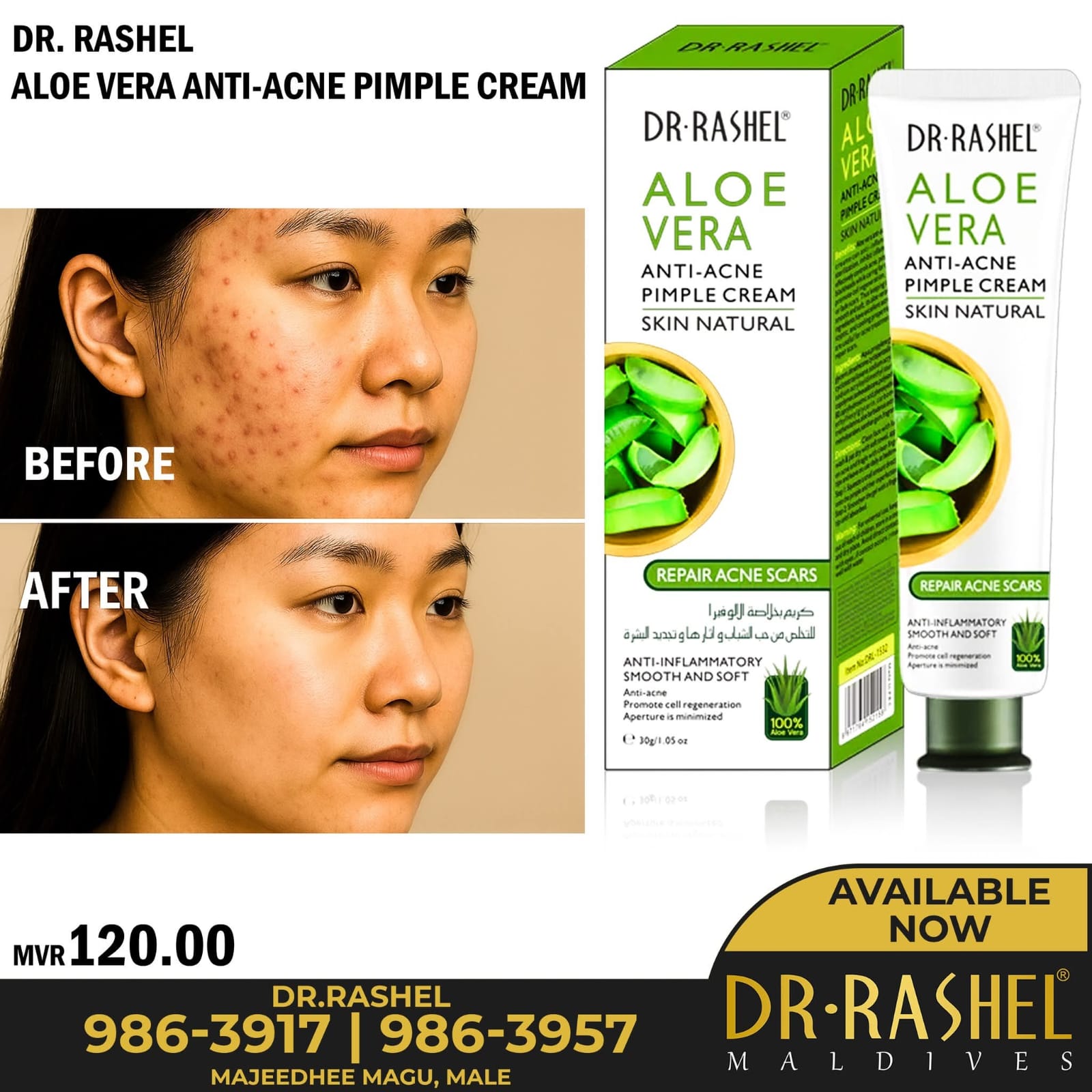 DR Rashel Aloe Vera Anti-Acne Pimple Cream 30g is an acne treatment product that uses the anti-inflammatory and healing properties of aloe vera to soothe skin, control breakouts, and fade acne scars.