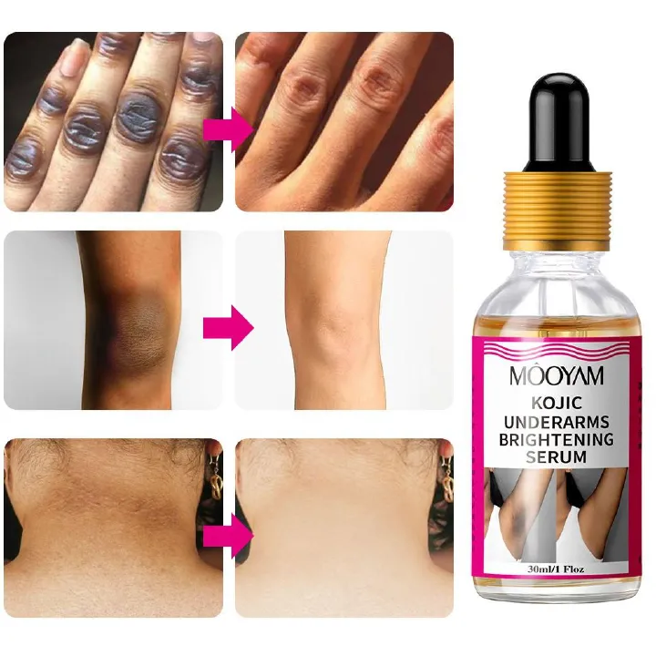 Body Whitening Underarms Armpits Whitening Kojic Acid Serum Bleach Brightening Underarm Elbow Knees Joint Removal Intimate Parts Dark Spots Melanin Snow Bleach Cream 30ml - MOOYAM