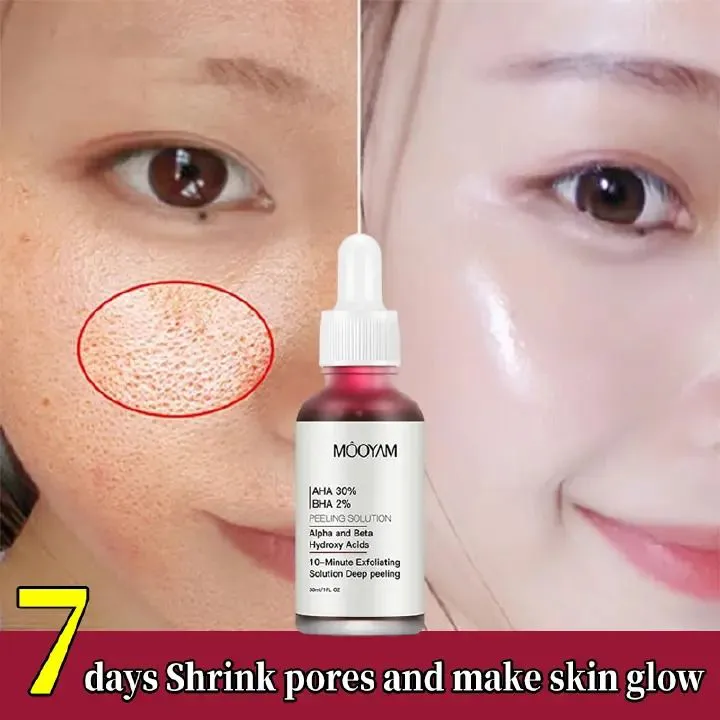 AHA 30% + BHA 2% Peeling Solutions, 30% AHA Glycolic Acid Peel With Lactic Acid Aloe Vera, Facial Exfoliator Exfoliating Peel Serum For Acne Pimple Spot 1 Fl Oz - MOOYAM