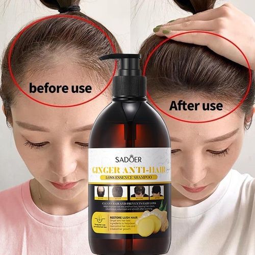 SADOER Anti Hair Loss Treatment Shampoo Essence, Hair Growth Ginger Extract Beard Growth,Hair Growth, Anti Dandruffs Hair Moisturizing Hair Care Shampoo, Derma Roller Compliment In Anti Hair Loss
