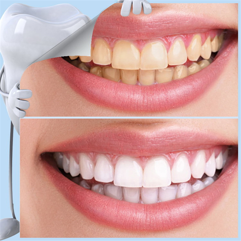 Tooth Dental Kit Teeth Whitening for False Teeth Veneers Dentist Seks Tools Oral Hygiene