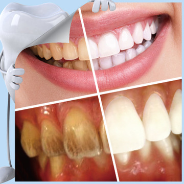 Tooth Dental Kit Teeth Whitening for False Teeth Veneers Dentist Seks Tools Oral Hygiene