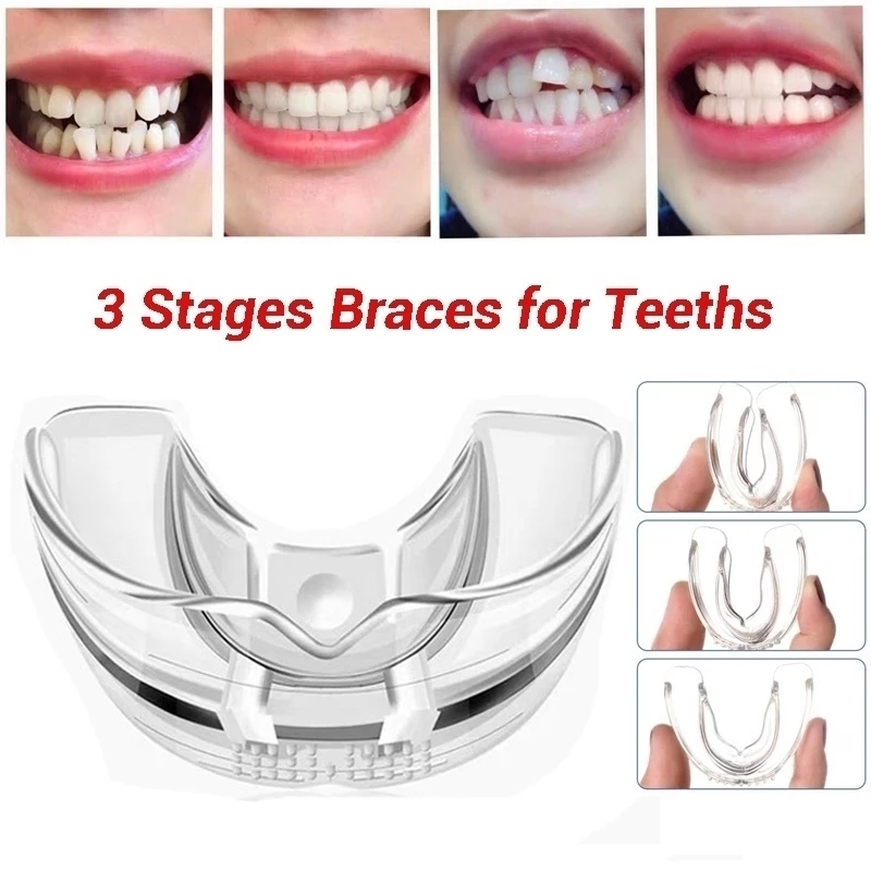 3 Stages Dental Orthodontic Teeth Corrector Braces Tooth Retainer Straighten Tools Adult Child
