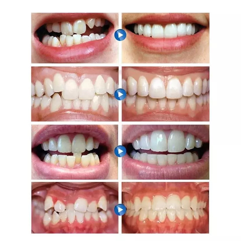 3 Stages Dental Orthodontic Teeth Corrector Braces Tooth Retainer Straighten Tools Adult Child