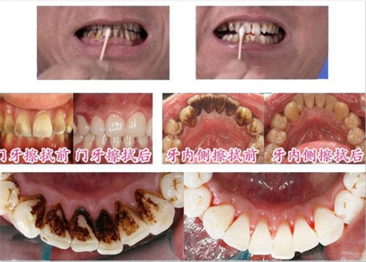 Teeth Whitening Quick Effect to Yellow Dental Plaque Dental Tattoo Black Stained Toothpaste Liquid