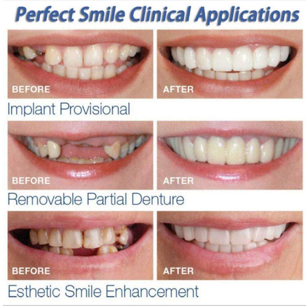 Snap On Smile - Instant Perfect Smile Clip On Veneers