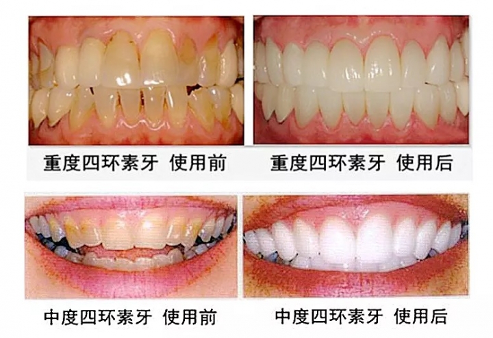 New style whitening paste 28 pieces of Advanced Teeth Whitening Strips tooth whitening paste