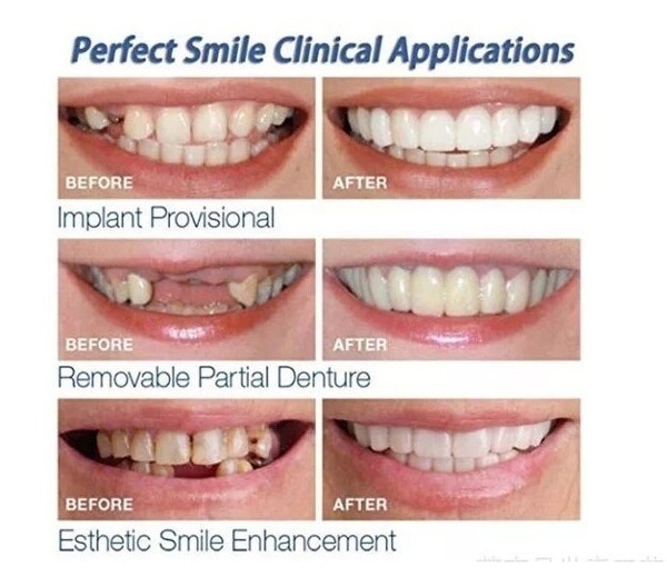 2 Pcs (Upper and Lower) Denture Instant Smile Comfort Fit Flex Cosmetic Teeth Top Cosmetic Veneer