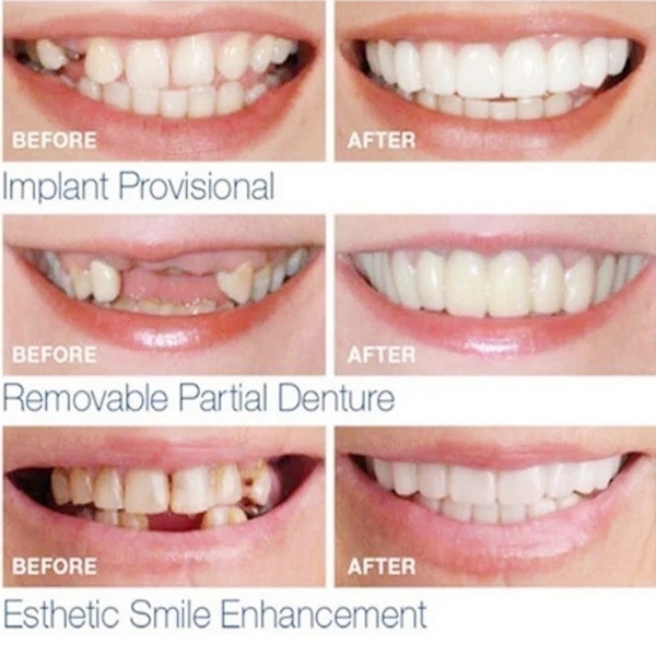 Oral Care Silicone Orthodontic  Dentures Are Suitable for Covering Cosmetic Comfort Whitening Teeth