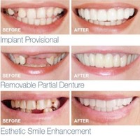 Quality Denture Instant Smile Comfort Fit Flex Cosmetic Teeth Denture Teeth Top Cosmetic Veneer
