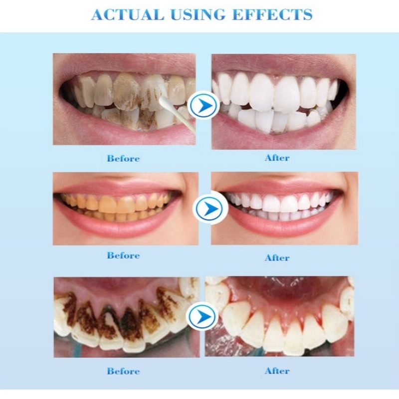 Teeth Whitening  Remove Plaque Stains Brighten Tooth Whitening Oral Hygiene Clean Serum Bleaching