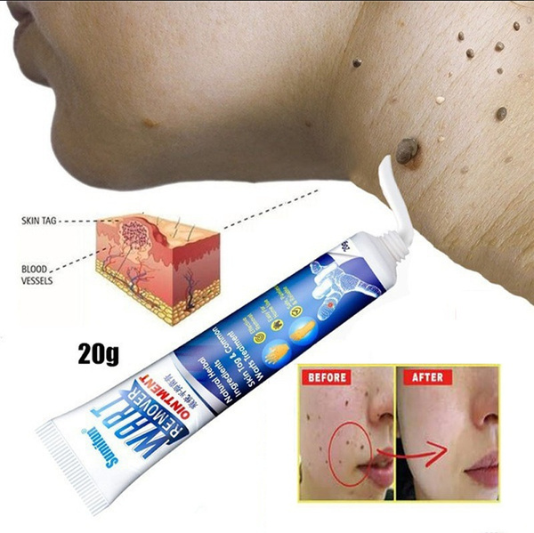 Portable Body Instant Blemish Removal Gel Warts Treatment Cream Foot Care Skin Tag Remover