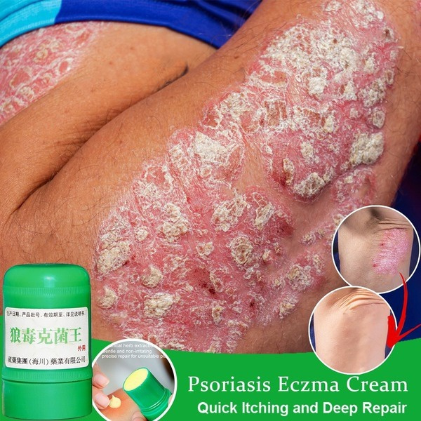 Skin Psoriasis Cream for All Kinds of Skin Problems Chinese Herbal Antibacterial Ointment Skin Care