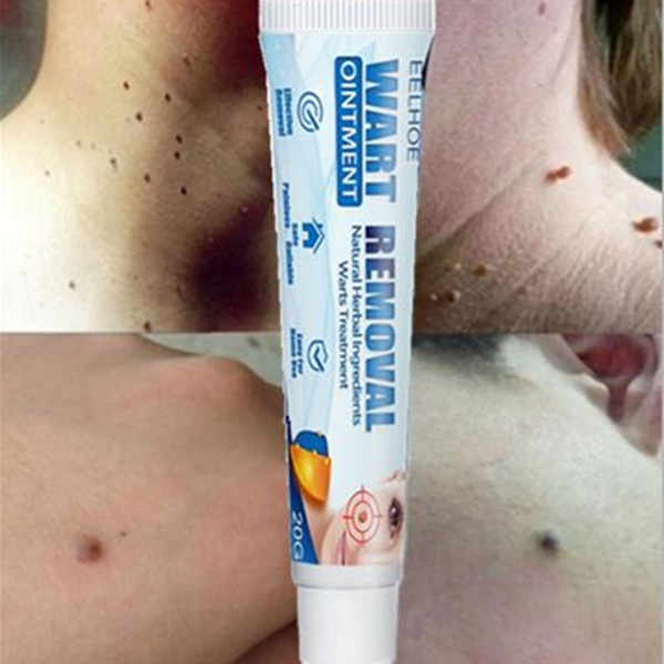 Skin Tag Remover Ointment Against Mole & Genital Wart Fast Remove Foot Corn Warts Rapidly Removes