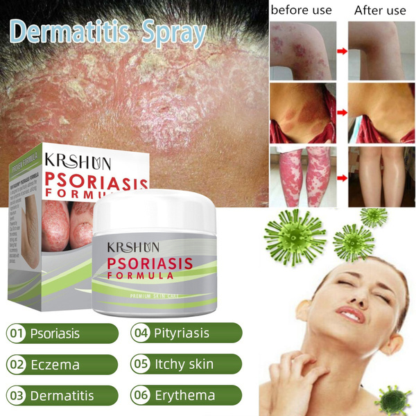 Treatment Psoriasis Cream Skin Care Antibacterial  Dermatitis Eczema Herbal Ointment Anti-Itch