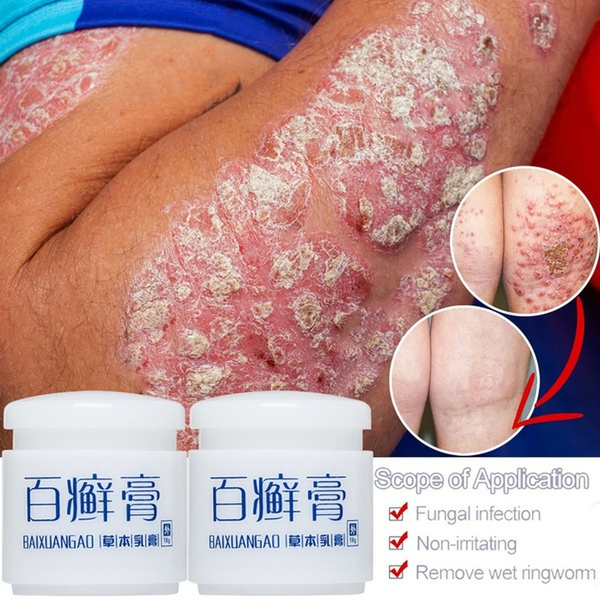Eczema Cream Skin Care Dermatitis Psoriasis Antibacterial Ointment Anti-itching Pain Relieving