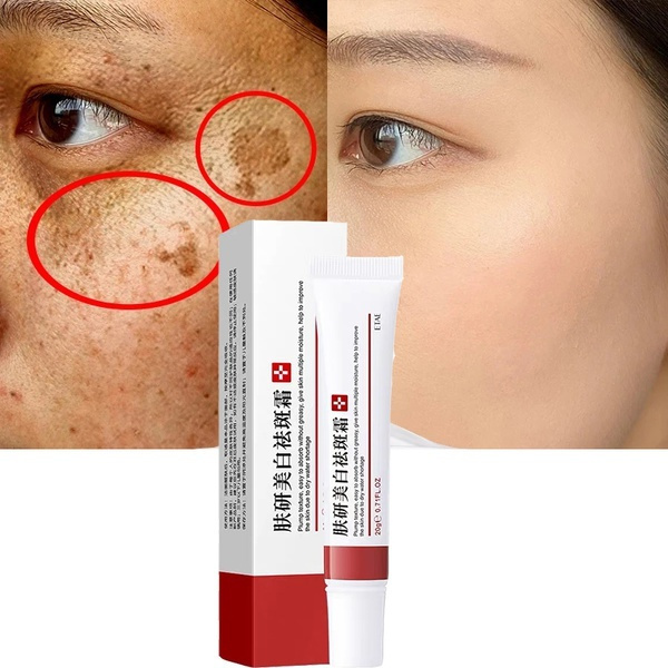 New Effective Whitening Freckle Cream Remove  Acne Spot Pigment Melanin Dark Spots Pigmentation