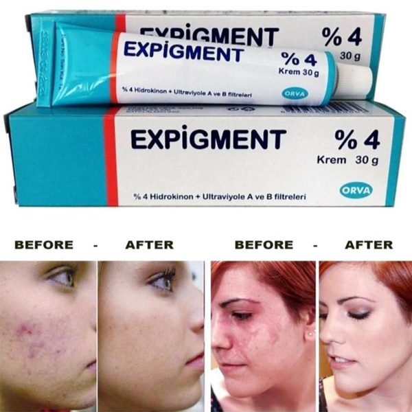 Expigment 4% Cream Whitening Skin Blackhead Remover Cream Acne Scar Face Care Original Product