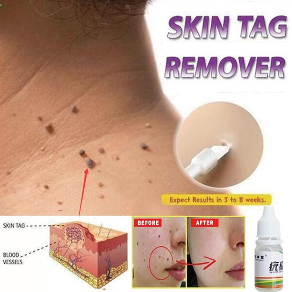 Tag Remover Warts Treatment Foot Corn Remover Plantar Warts  Foot Care Medical Plaster Ointment