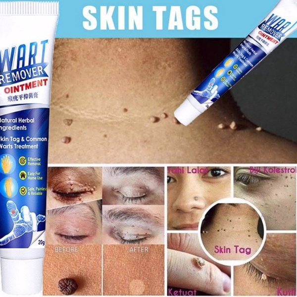 20g New Warts Remover Ointment Wart Treatment Cream Skin Tag Remover Herbal Extract Foot Corn Antibacterial Warts Ointment Papillomas Rapidl