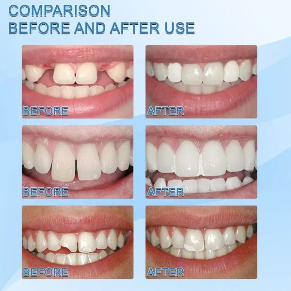 30ml Temporary Tooth Repair Kit False Teeth Solid Glue Denture For Missing Broken Teeth Moldable Tooth Filling False Teeth Tool