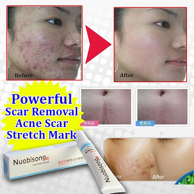 Switzerland Nuobisong Powerful Anti-Scar Anti-Black Spots Anti-Acne