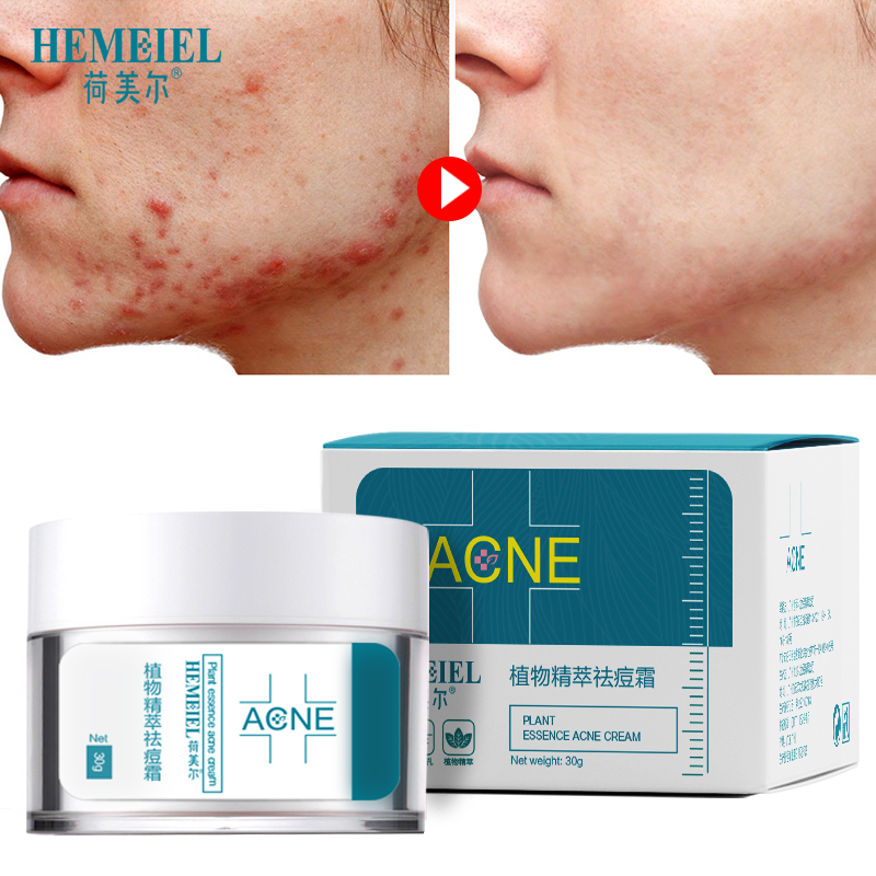 Herbal Anti-Acne Cream Oily Skin Acne Stains Moisturizing Acne Treatment Face Cream Care Acne Scar Remove Skin Care