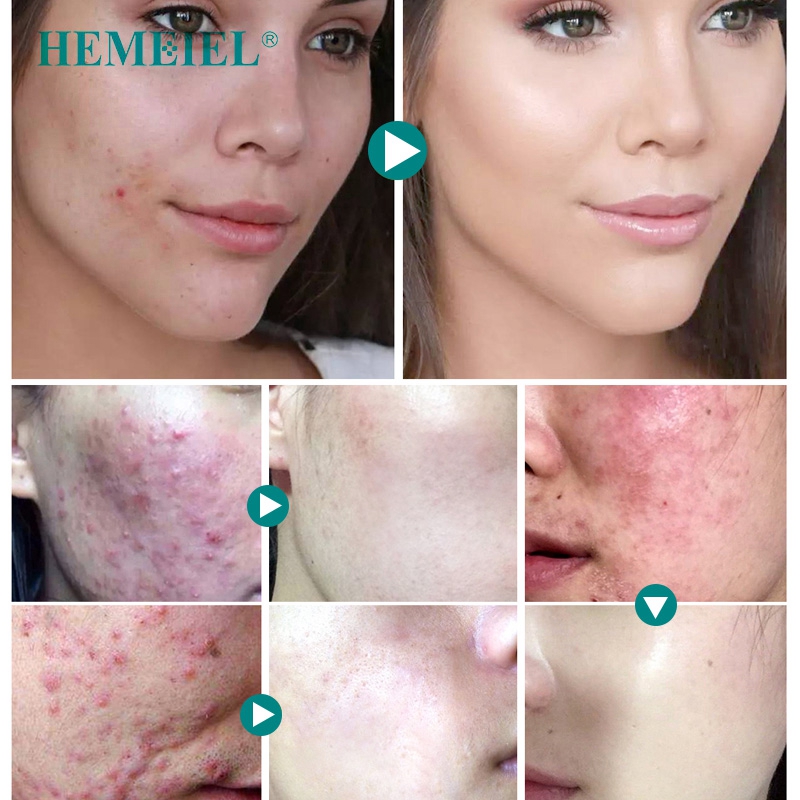 Herbal Anti-Acne Cream Oily Skin Acne Stains Moisturizing Acne Treatment Face Cream Care Acne Scar Remove Skin Care