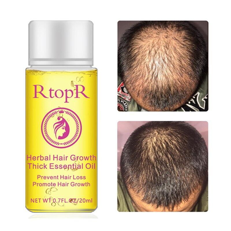 RtopR Hair Growth Essential Oil 20ml Herbal Fast Longer Thick Essence Professional Anti-hair loss