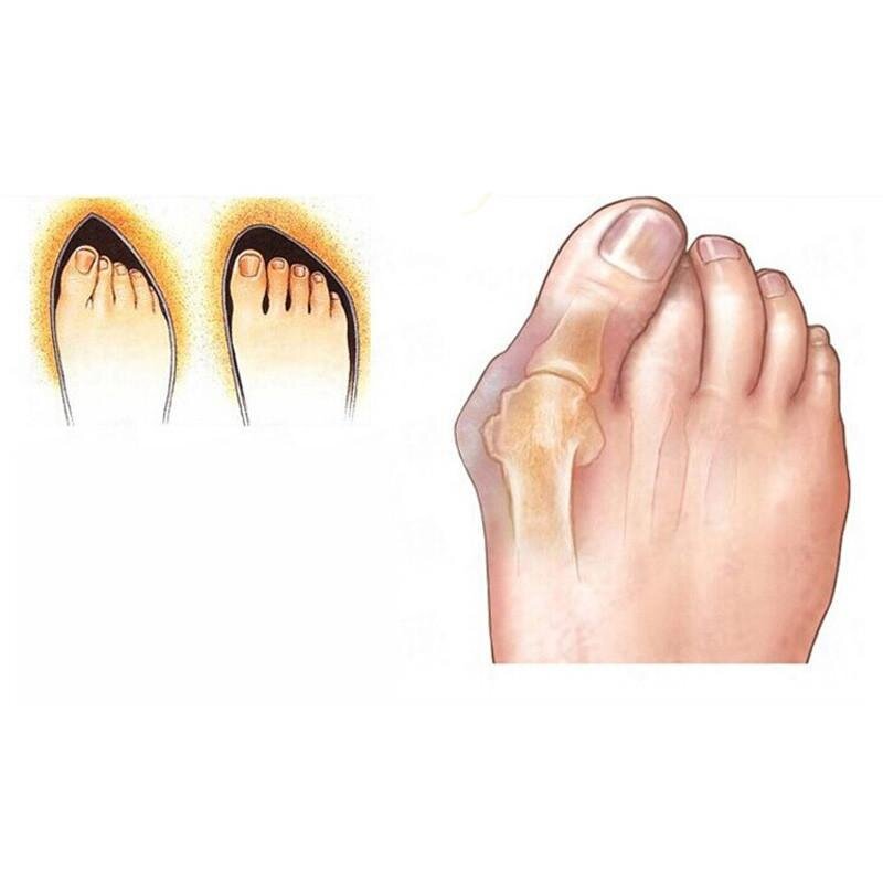 2 x Hallux Valgus/Bunion Corrector - Silicone Toe Separator