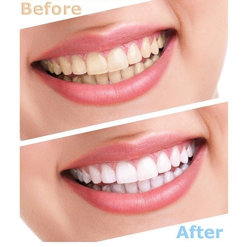 2pcs Dental Teeth Whitening Light LED Bleaching Teeth Accelerator Whitening Tooth Cosmetic Laser