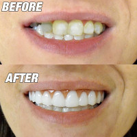 Comfortable Whitening Teeth Fake Cosmetic Tooth Denture Silicone Smile Veneers Beauty Tool False