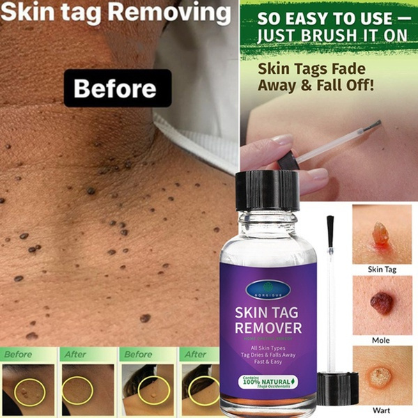 10/20/30ml Mole&Skin Tag Removal Solution Painless Mole Skin Dark Spot Removal Face Wart Tag Removal