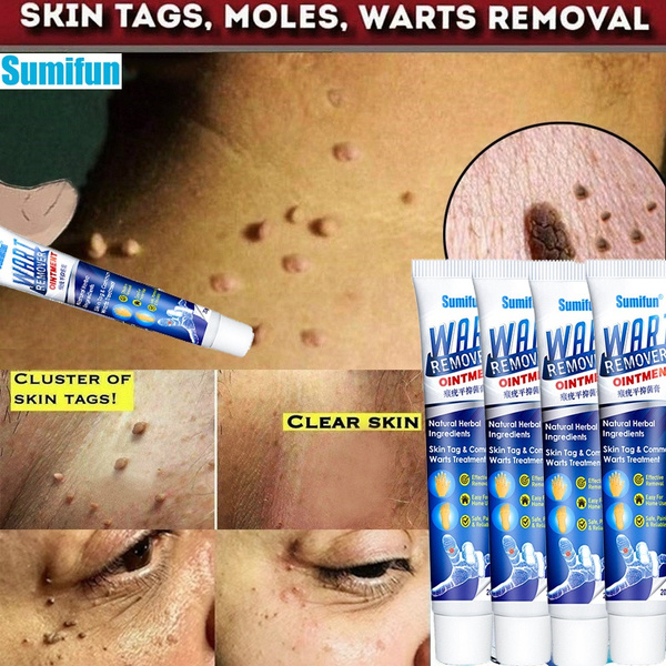 Warts Remover Ointment Wart Treatment Cream Skin Tag Remover Herbal Extract Corn Plaster Warts