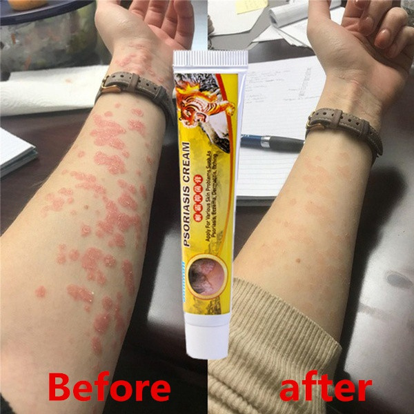Tiger Balm Eczema Cream Anti-itching Psoriasis Antibacterial Dermatitis Chinese Herbal Medical Ointment