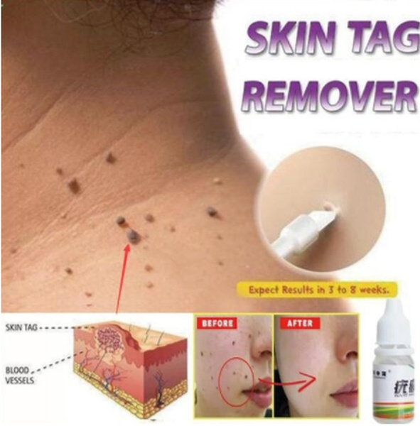 Removal Warts Treatment Foot Corn Removal Plantar Warts  Foot Care Medical Plaster