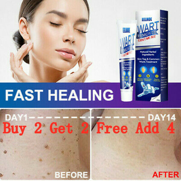 Instant blemish removal ointment body wart remover skin nodule treatment cream