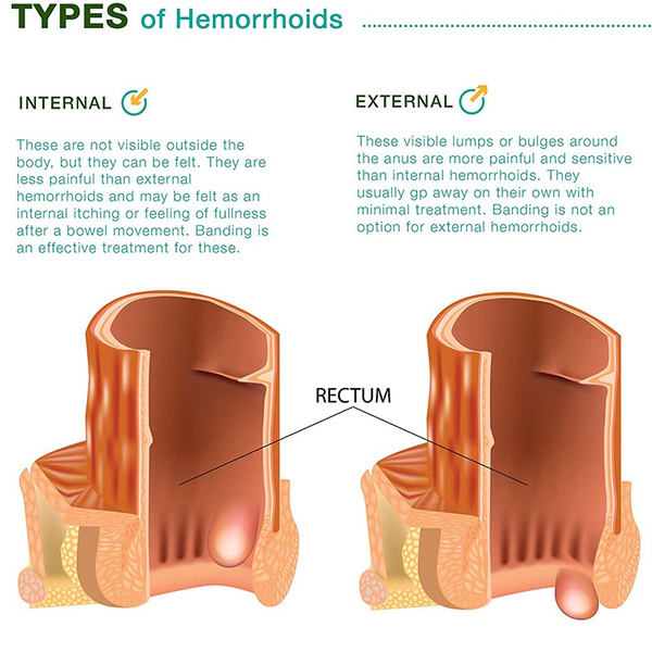 Hemorrhoid Fissure Cream Ointment Fast Relief Portable for Women Men Adult