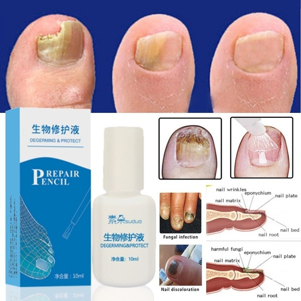 Chinese Medicine Herbs Toe Nail Fungus Treatment Massage Anti Fungal Nail Infection Nail Care