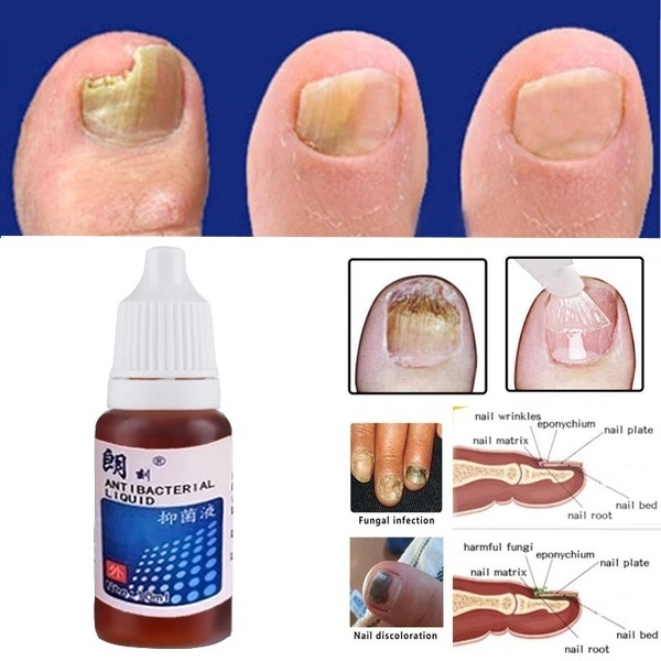 Chinese Medicine Herbs Toe Nail Fungus Treatment Massage Anti Fungal Nail Infection Nail Care