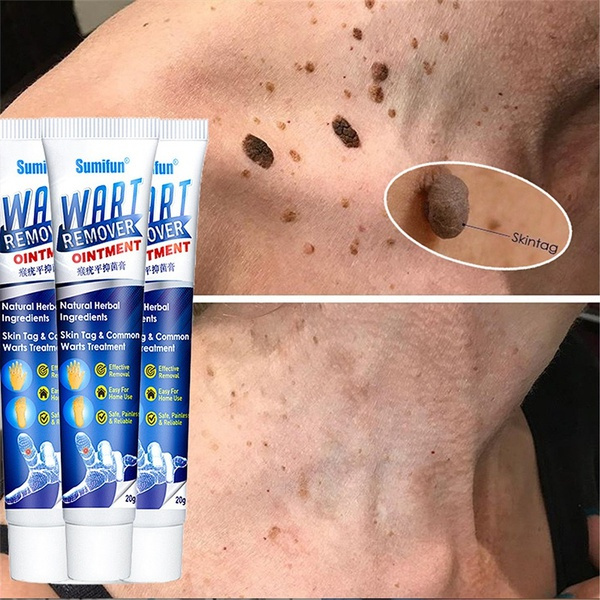 2021  New   20g Warts Remover Ointment Wart Treatment Cream Skin Tag Remover Herbal Extract Corn Plaster Warts Ointment
