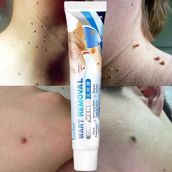 1Pcs Skin Tag Remover Ointment Against Mole & Genital Wart Fast Remove Foot Corn Warts Papillomas Rapidly Removes Moles Cream