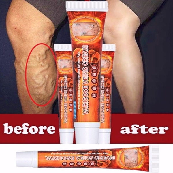 NEW 20g Varicose Veins Ointmnet Vasculitis Phlebitis Spider Cream Varicosity Angiitis Removal Herbal Medical Plaster Arrow