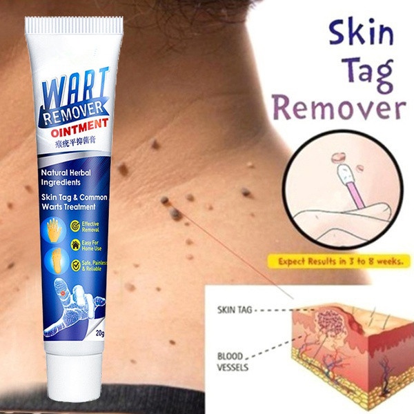 20g New Warts Remover Ointment Wart Treatment Cream Skin Tag Remover Herbal Extract Foot Corn Antibacterial Warts Ointment Papillomas Rapidl
