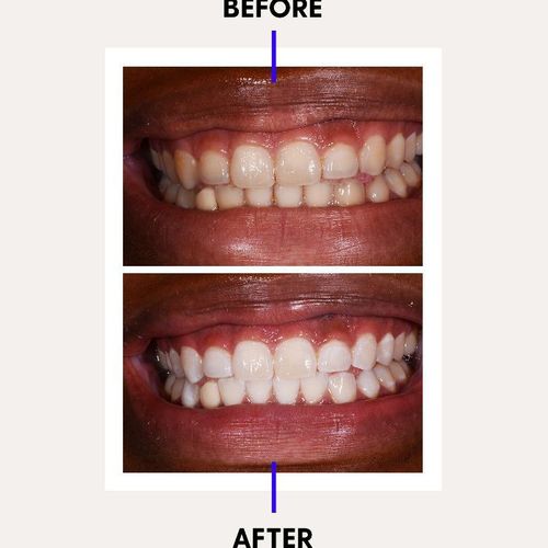 Dr. Rashel Charcoal Whitening Toothpaste Coffee Tea Cigarette Stains