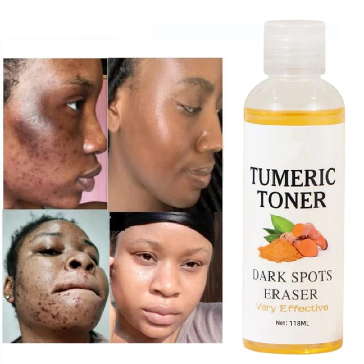 Quick Dark Spots Corrector Serum Tumeric Toner Acne Remover Fade Dark Spots Eraser Skin Care Serum- MOOYAM -