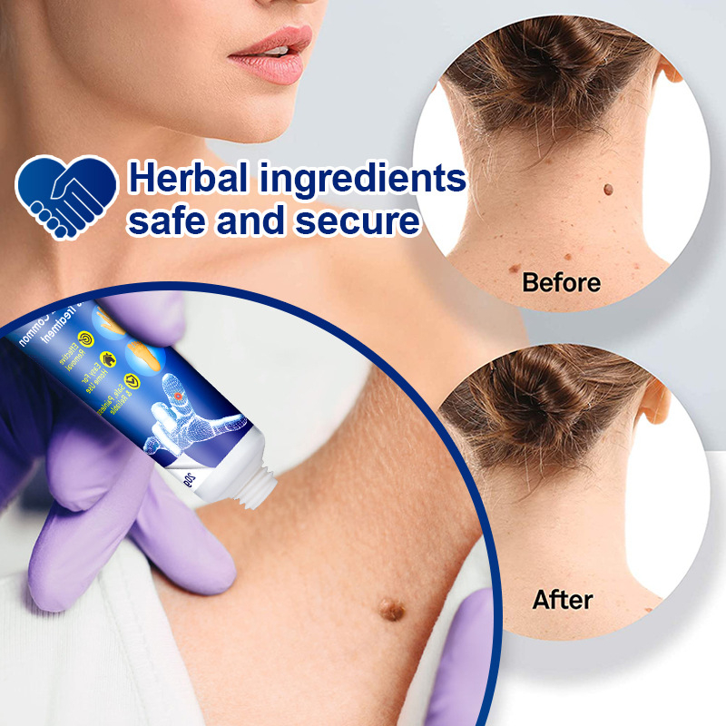 Warts Remover Cream Wart Treatment Cream Skin Tag Remover Foot Corn Antibacterial Warts Cream