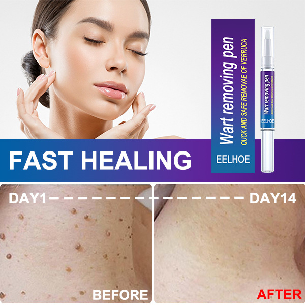 Warts Remover Cream Wart Treatment Cream Skin Tag Remover Foot Corn Antibacterial Warts Cream Latest upgrade version
